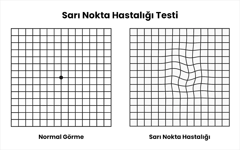 Sarı Nokta Hastalığı Testi