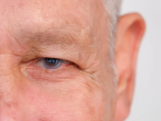 Dar Açılı Glokom (Akut Açı Kapanması)