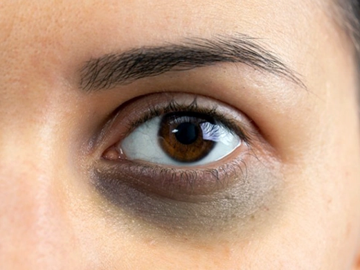 Göz Altı Morlukları Tedavisi