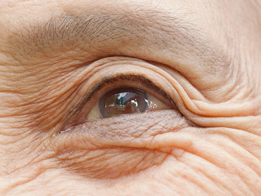 Normal Basınçlı Glokom