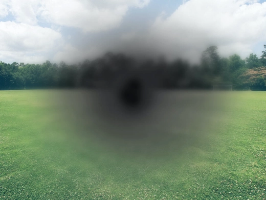 Yaşa Bağlı Makula Dejenerasyonunda (Sarı Nokta) Yeni Tedaviler